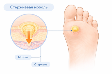 Стержневая мозоль. Кожное образование с выраженным центральным стержнем. Вызывает боль и дискомфорт при ходьбе